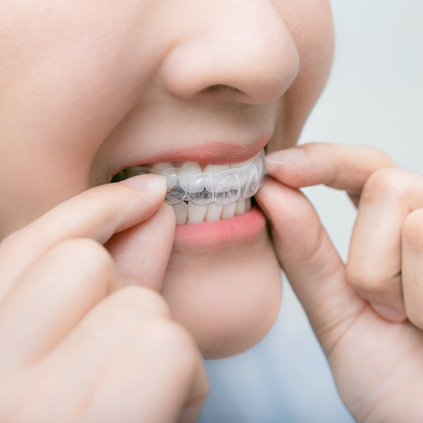 East Brunswick Clear Aligners