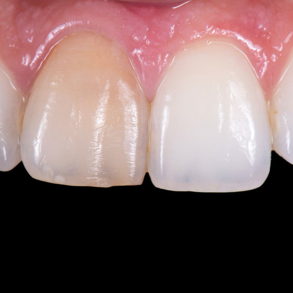 Dental Veneers East Brunswick