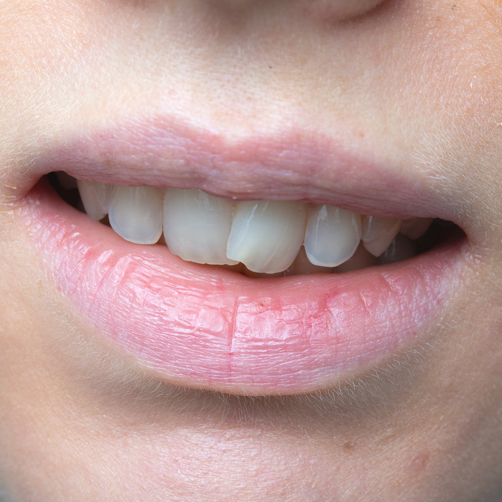 Dental Veneers in East Brunswick